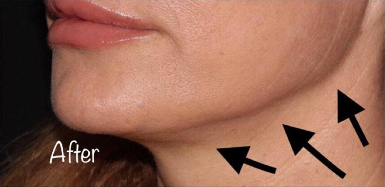 Beverly Hills Aesthetics neck lift result — Los Angeles, CA