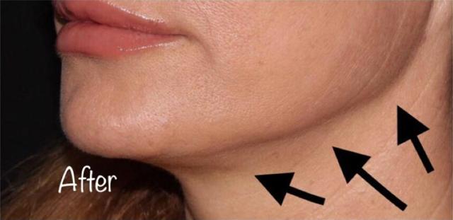 Neck Lift result at Beverly Hills Aesthetics in Los Angeles, CA