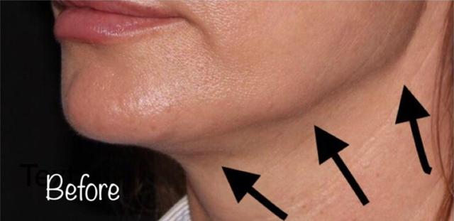 Neck Lift result at Beverly Hills Aesthetics in Los Angeles, CA