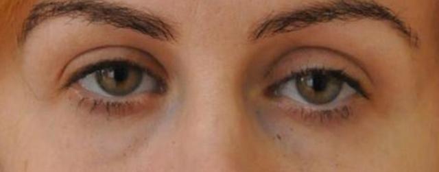 Blepharoplasty result at Beverly Hills Aesthetics in Los Angeles, CA