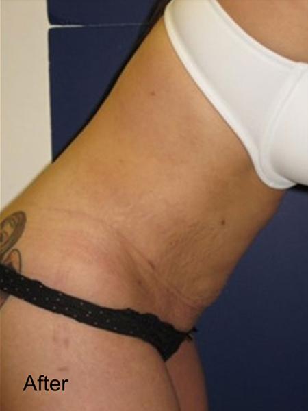 Tummy Tuck after at Beverly Hills Aesthetics in Los Angeles, CA
