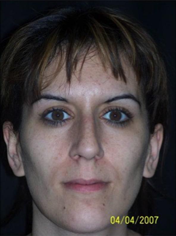 Functional Rhinoplasty before at Beverly Hills Aesthetics in Los Angeles, CA