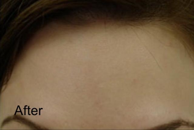 Botox after at Beverly Hills Aesthetics in Los Angeles, CA