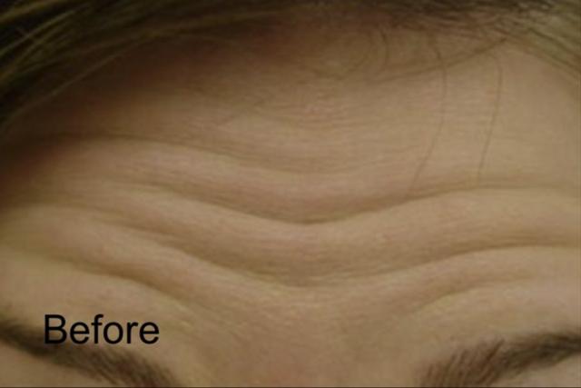 Botox before at Beverly Hills Aesthetics in Los Angeles, CA