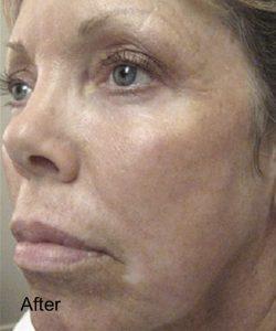 Beverly Hills Aesthetics laser treatment after — Los Angeles, CA