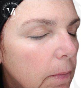 Chemical Peel after at Beverly Hills Aesthetics in Los Angeles, CA