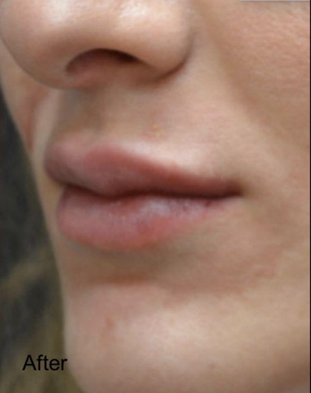 Lip Filler after at Beverly Hills Aesthetics in Los Angeles, CA
