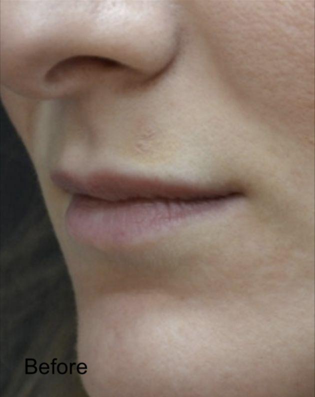 Lip Filler before at Beverly Hills Aesthetics in Los Angeles, CA