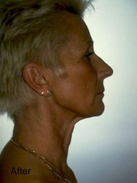 Deep Plane Facelift after at Beverly Hills Aesthetics in Los Angeles, CA