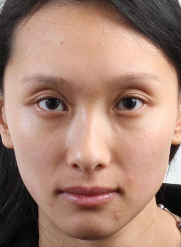 Brow Lift before at Beverly Hills Aesthetics in Los Angeles, CA
