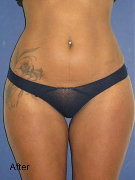 Liposuction after at Beverly Hills Aesthetics in Los Angeles, CA