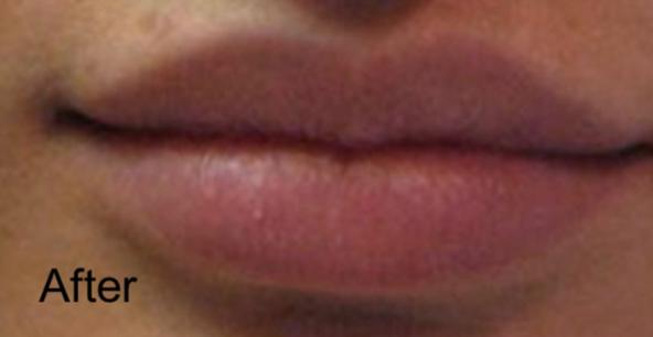 Beverly Hills Aesthetics result — Los Angeles, CA