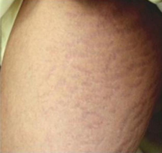 Beverly Hills Aesthetics microneedling after — Los Angeles, CA