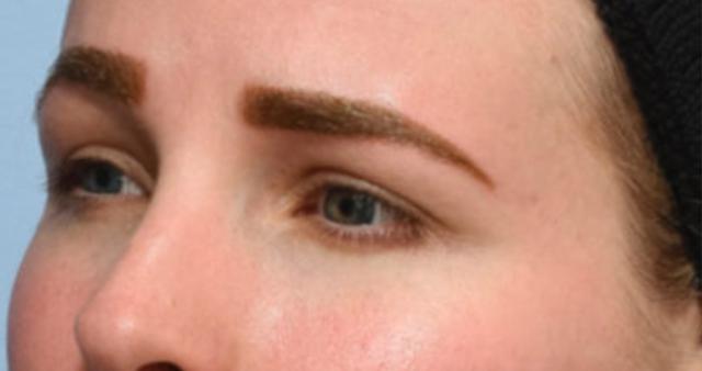 Brow Lift before at Beverly Hills Aesthetics in Los Angeles, CA