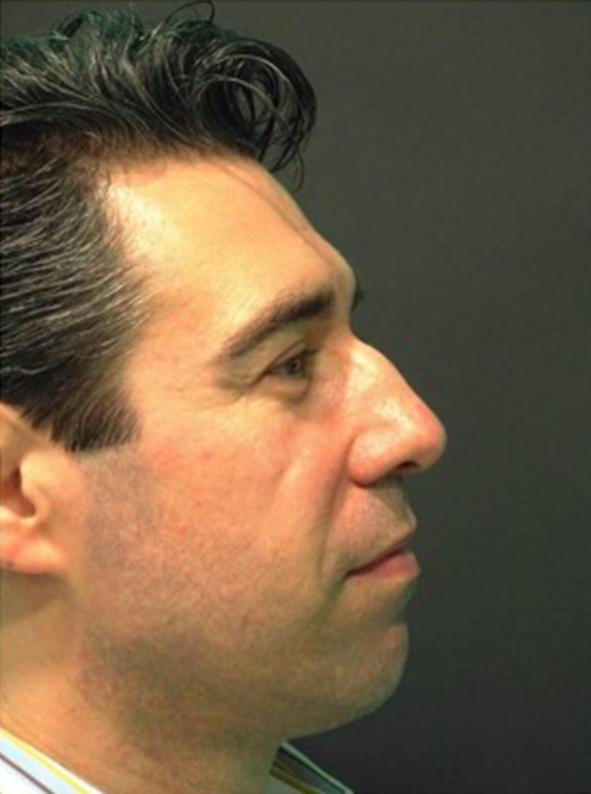 Rhinoplasty before at Beverly Hills Aesthetics in Los Angeles, CA