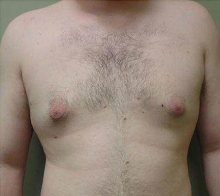 Gynecomastia Surgery after at Beverly Hills Aesthetics in Los Angeles, CA