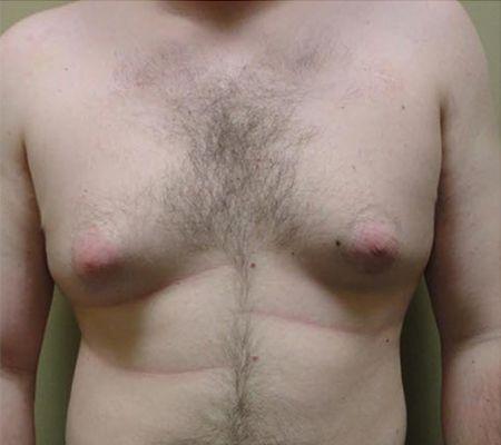 Gynecomastia Surgery before at Beverly Hills Aesthetics in Los Angeles, CA