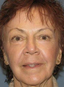 Beverly Hills Aesthetics laser treatment after — Los Angeles, CA