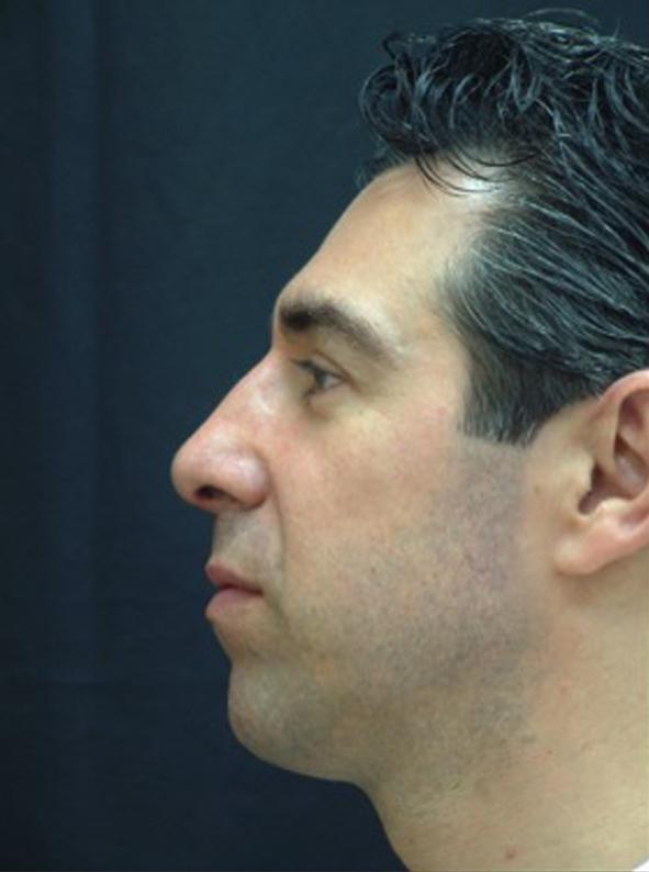 Rhinoplasty after at Beverly Hills Aesthetics in Los Angeles, CA
