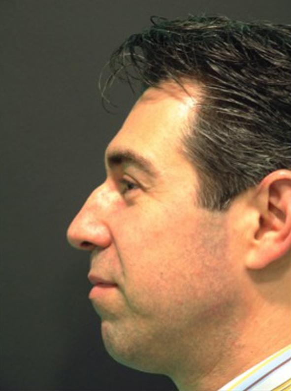 Rhinoplasty before at Beverly Hills Aesthetics in Los Angeles, CA
