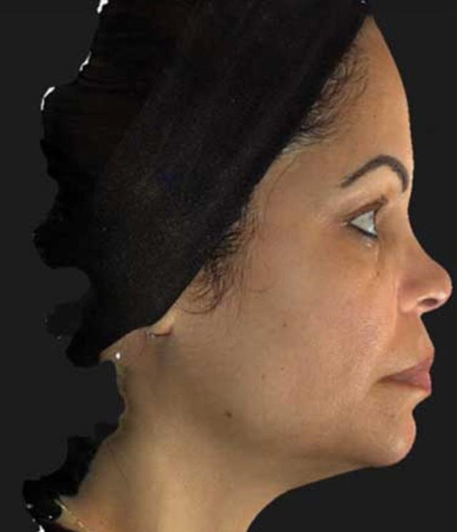 Neck Lift after at Beverly Hills Aesthetics in Los Angeles, CA