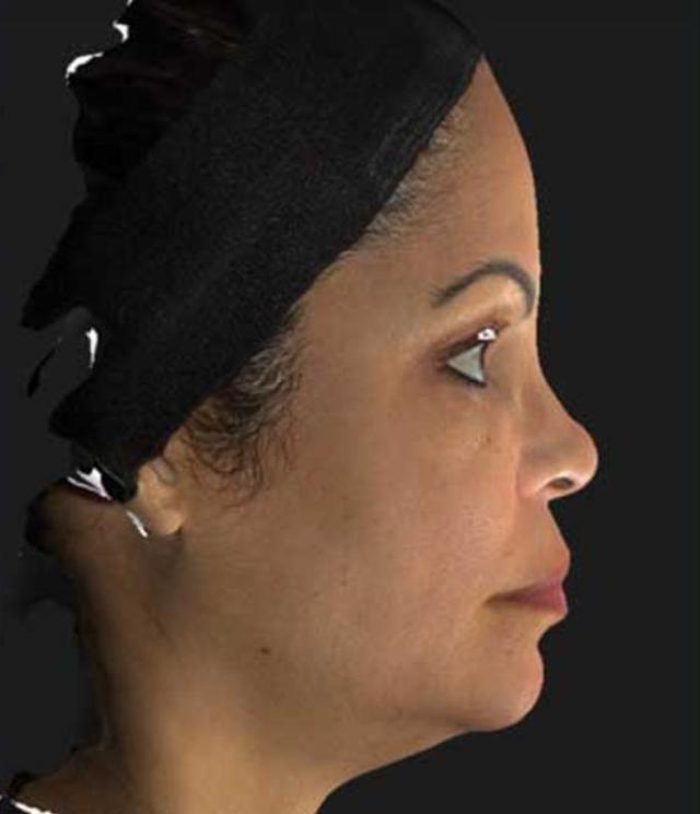Neck Lift before at Beverly Hills Aesthetics in Los Angeles, CA