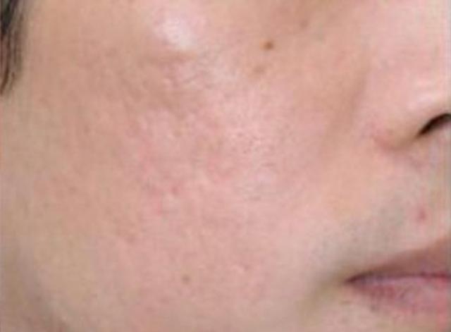 Microneedling after at Beverly Hills Aesthetics in Los Angeles, CA