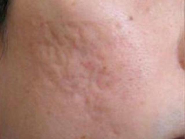 Microneedling before at Beverly Hills Aesthetics in Los Angeles, CA