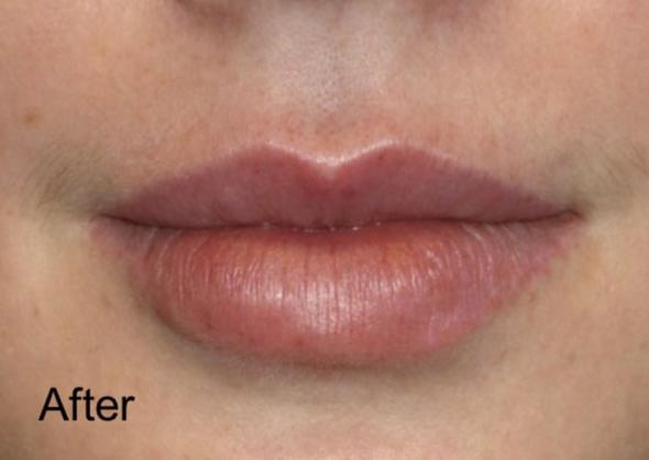 Lip Filler after at Beverly Hills Aesthetics in Los Angeles, CA