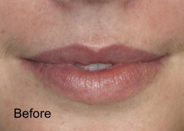 Lip Filler before at Beverly Hills Aesthetics in Los Angeles, CA