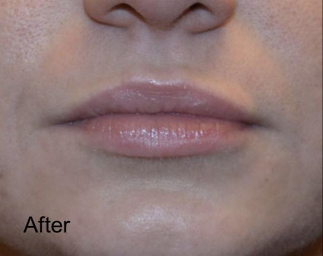 Lip Filler after at Beverly Hills Aesthetics in Los Angeles, CA