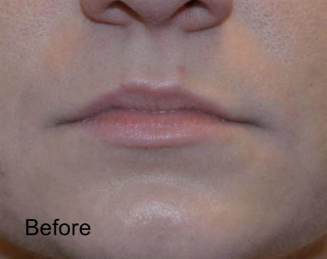 Lip Filler before at Beverly Hills Aesthetics in Los Angeles, CA