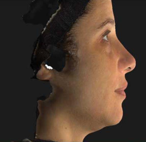 Neck Lift before at Beverly Hills Aesthetics in Los Angeles, CA