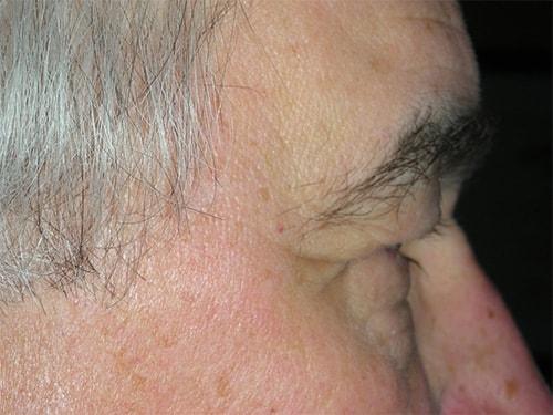 Blepharoplasty before at Arkansas Oculoplastic Surgery, PLLC: Brock Wade D MD in Little Rock, AR