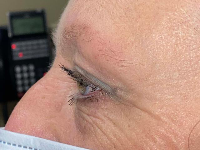 Blepharoplasty after at Arkansas Oculoplastic Surgery, PLLC: Brock Wade D MD in Little Rock, AR