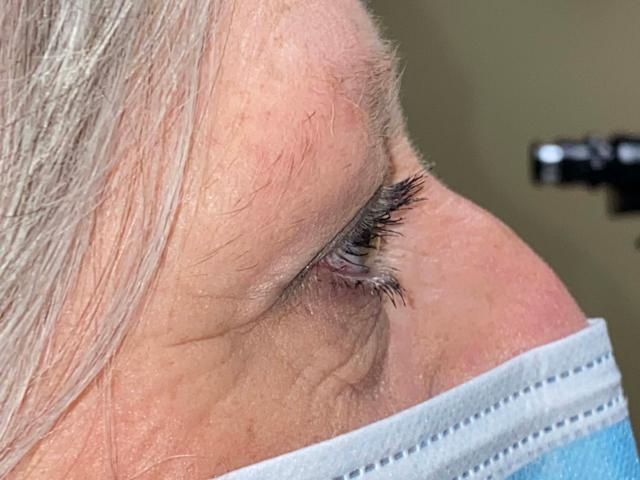 Blepharoplasty after at Arkansas Oculoplastic Surgery, PLLC: Brock Wade D MD in Little Rock, AR