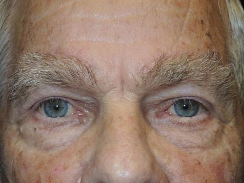 Blepharoplasty after at Arkansas Oculoplastic Surgery, PLLC: Brock Wade D MD in Little Rock, AR