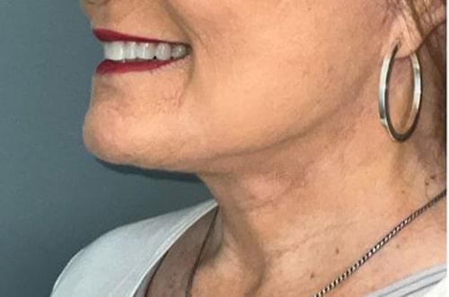 Arkansas Oculoplastic Surgery, PLLC: Brock Wade D MD neck lift after — Little Rock, AR