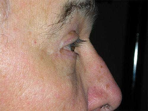 Arkansas Oculoplastic Surgery, PLLC: Brock Wade D MD eyelid lift after — Little Rock, AR