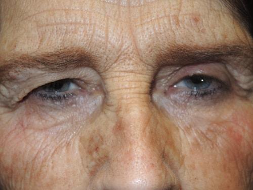 Blepharoplasty before at Arkansas Oculoplastic Surgery, PLLC: Brock Wade D MD in Little Rock, AR