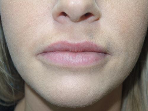 Lip Filler after at Arkansas Oculoplastic Surgery, PLLC: Brock Wade D MD in Little Rock, AR