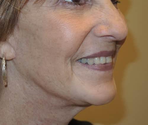 Deep Plane Facelift before at Arkansas Oculoplastic Surgery, PLLC: Brock Wade D MD in Little Rock, AR