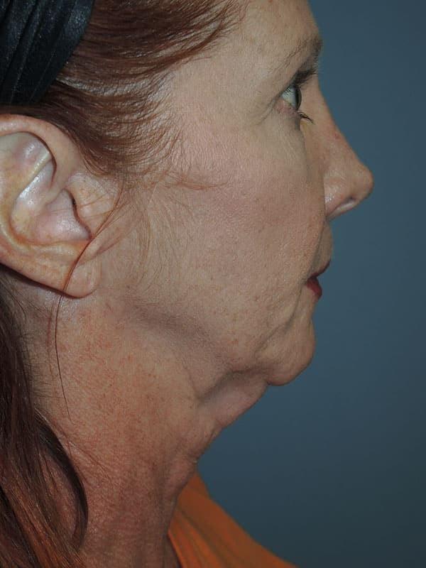 Deep Plane Facelift before at Arkansas Oculoplastic Surgery, PLLC: Brock Wade D MD in Little Rock, AR