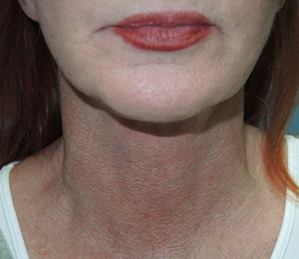 Deep Plane Facelift after at Arkansas Oculoplastic Surgery, PLLC: Brock Wade D MD in Little Rock, AR