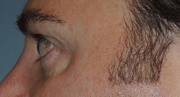 Jawline Filler before at Arkansas Oculoplastic Surgery, PLLC: Brock Wade D MD in Little Rock, AR