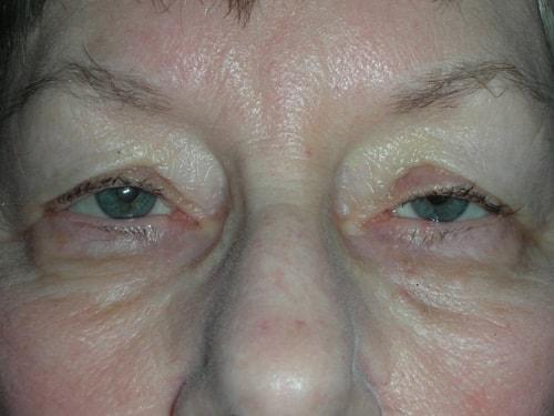 Blepharoplasty before at Arkansas Oculoplastic Surgery, PLLC: Brock Wade D MD in Little Rock, AR