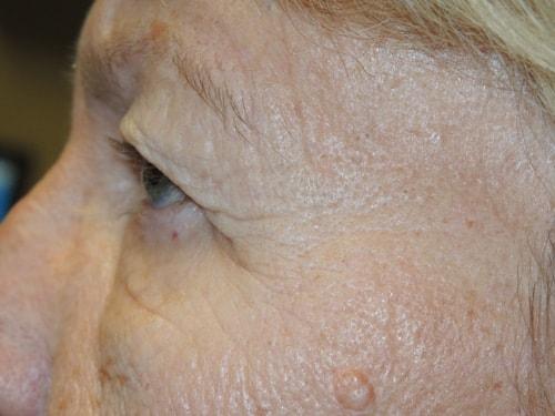 Blepharoplasty before at Arkansas Oculoplastic Surgery, PLLC: Brock Wade D MD in Little Rock, AR