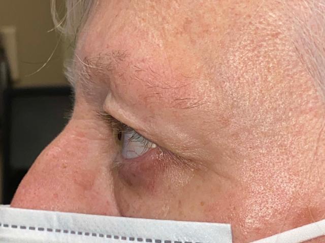 Blepharoplasty before at Arkansas Oculoplastic Surgery, PLLC: Brock Wade D MD in Little Rock, AR