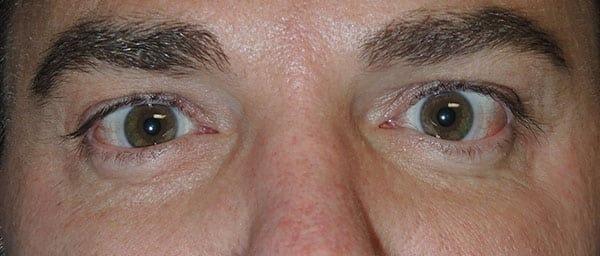 Dermal Fillers before at Arkansas Oculoplastic Surgery, PLLC: Brock Wade D MD in Little Rock, AR