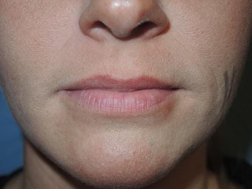 Lip Filler before at Arkansas Oculoplastic Surgery, PLLC: Brock Wade D MD in Little Rock, AR